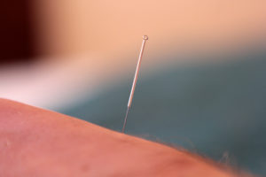 gentle acupuncture